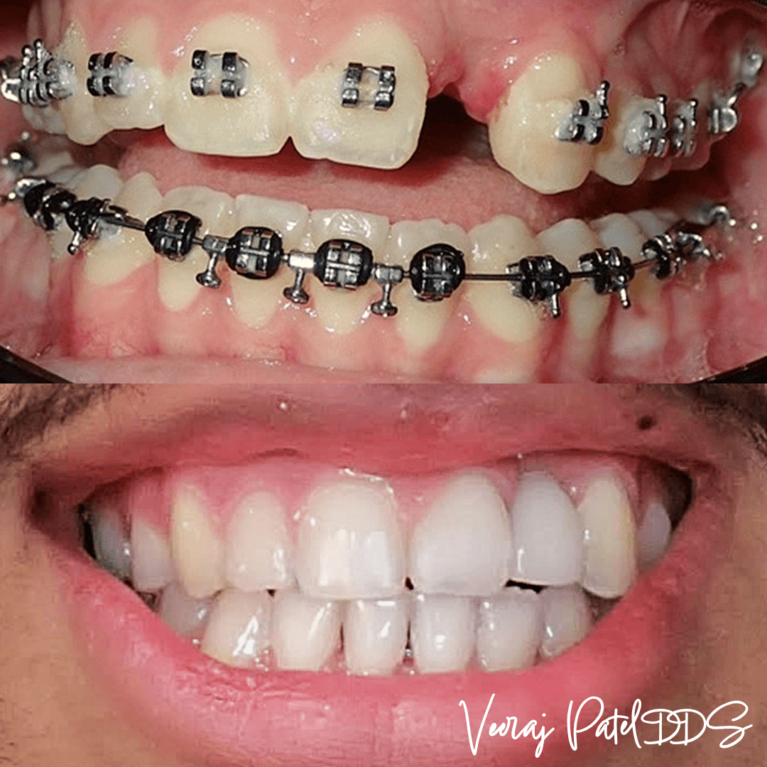 Dental bridge model showing supporting crowns