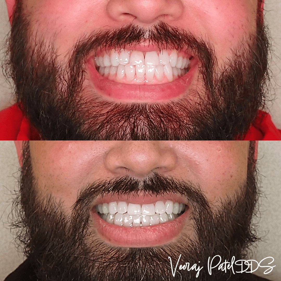 Clear Invisalign aligner held over a smile