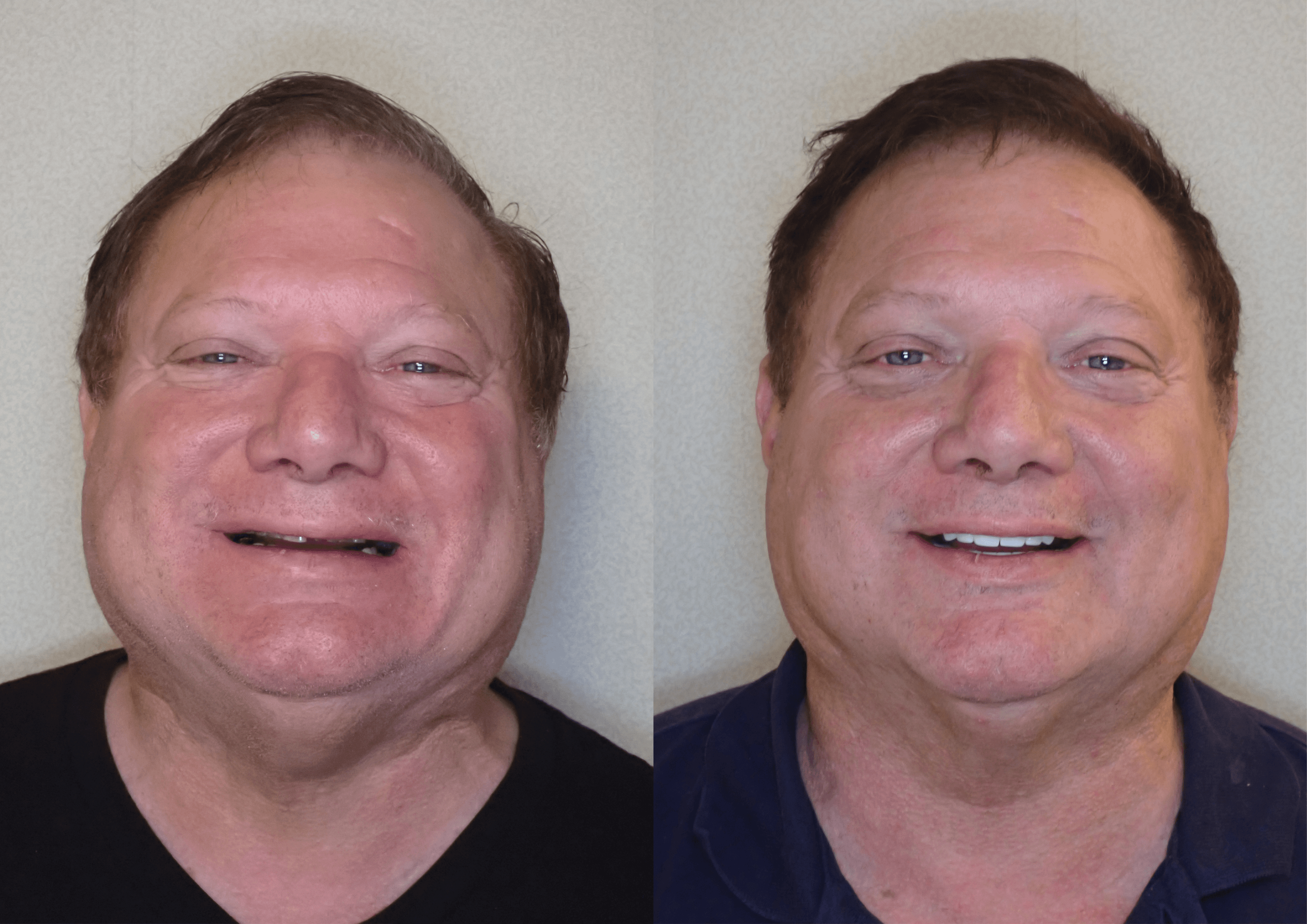 Patient admiring her completed smile makeover